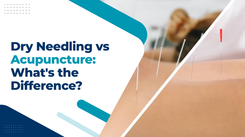Dry needling vs acupuncture: understand the key differences, benefits, and treatment approaches at Back To Ease Physio.