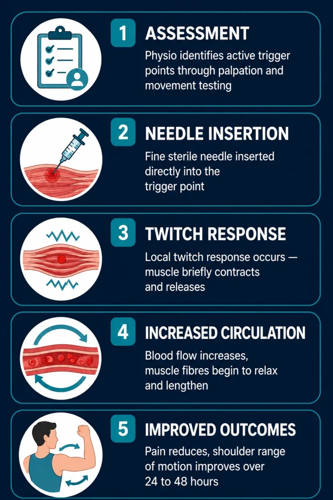 What Actually Happens During Dry Needling for the Shoulder