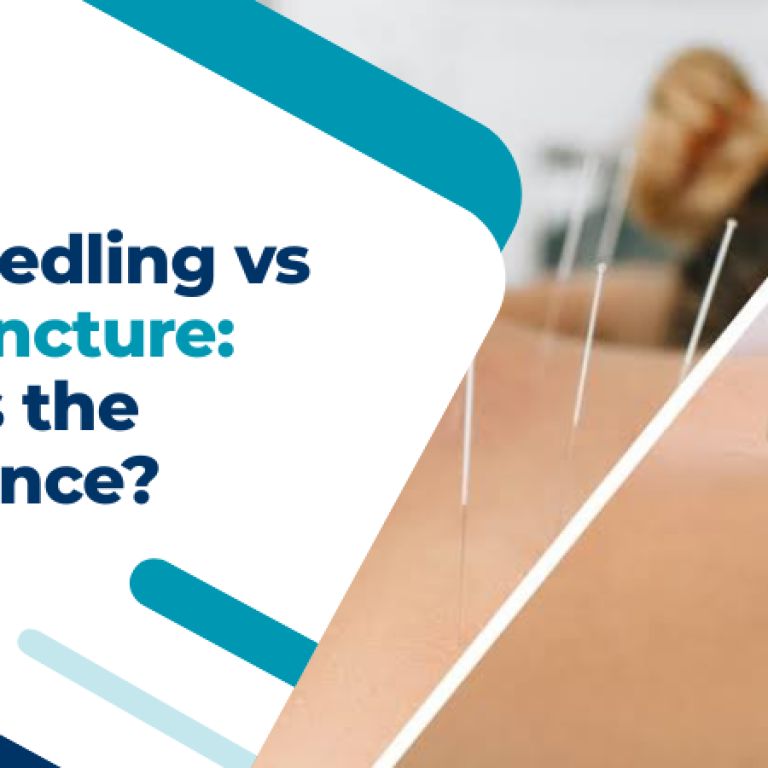 Dry needling vs acupuncture: understand the key differences, benefits, and treatment approaches at Back To Ease Physio.